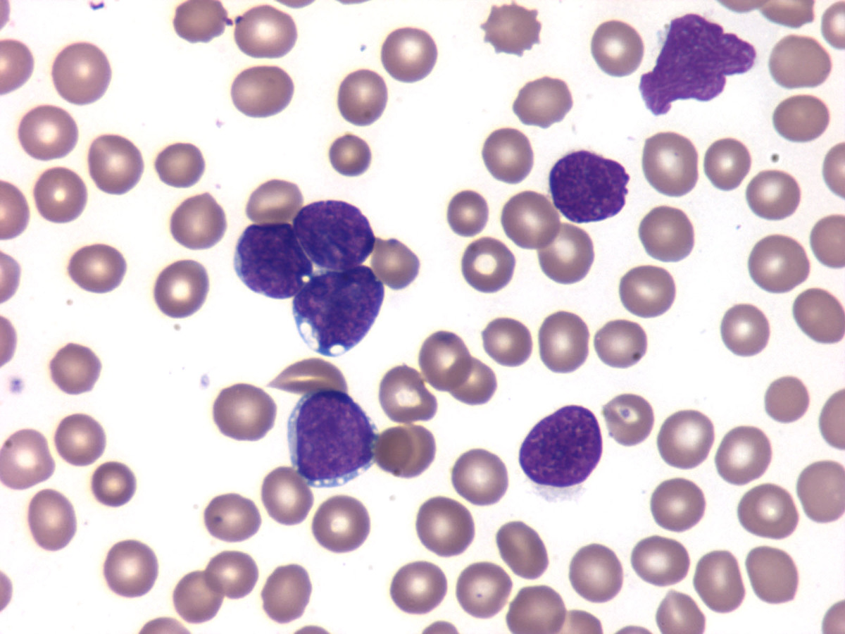 Blasts in peripheral blood